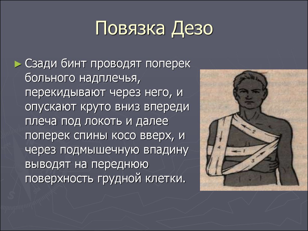 Повязка это. Десмургия повязка Дезо. Повязка Дезо с41орлиман. Повязка Дезо сзади. Повязки по назначению.