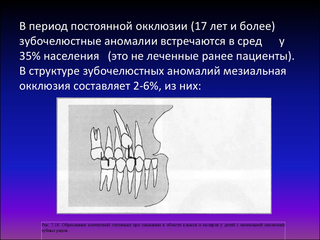 В период постоянной окклюзии (17 лет и более) зубочелюстные аномалии встречаются в сред у 35% населения (это не леченные ранее пациенты). В стр