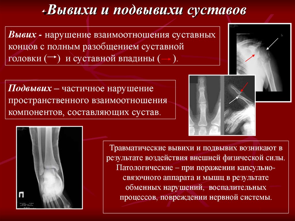 Рентгеновская картина переломов и вывихов костей