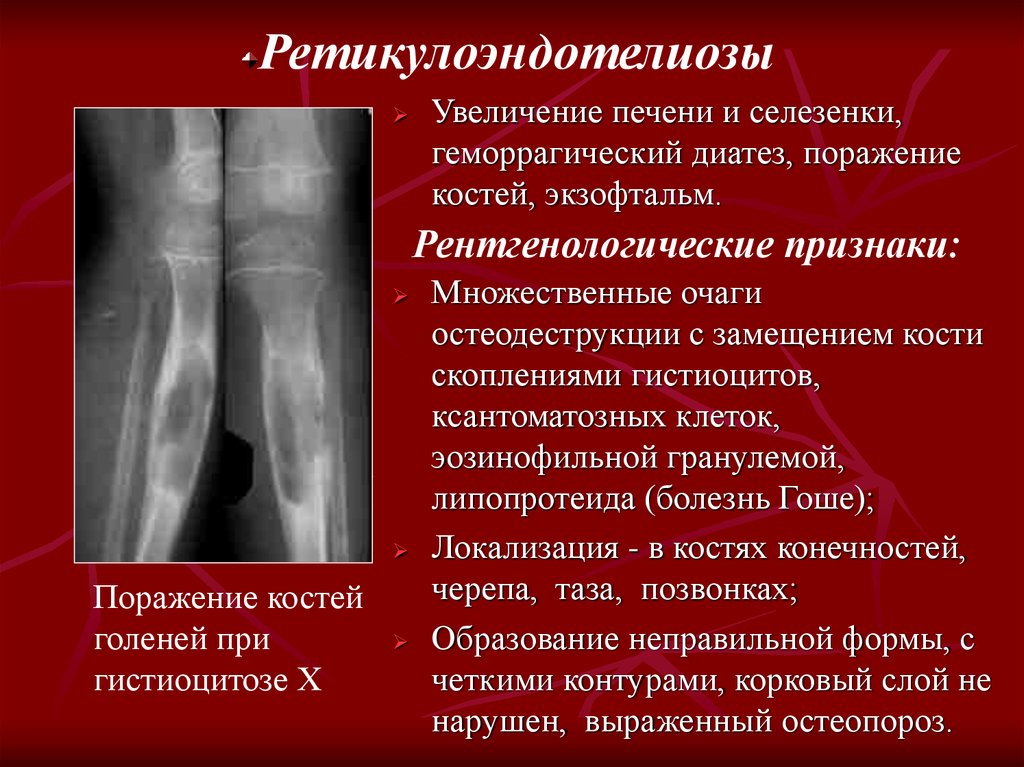 Болезни костя. Рентгенологические заболевания костей и суставов. Поражение костей и суставов инфекцией.