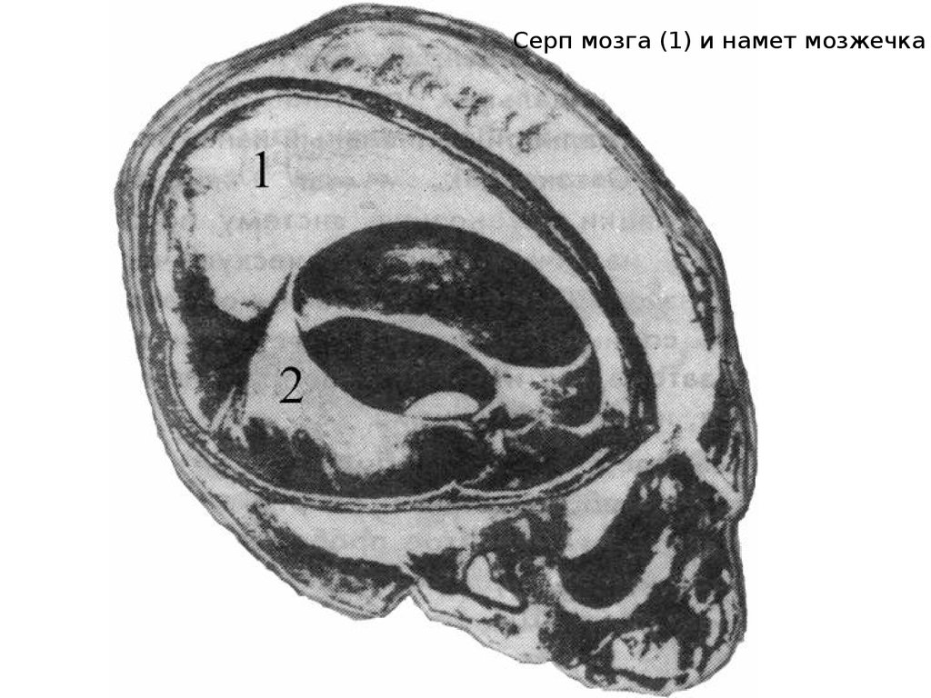 Серп большого мозга. Серп большого мозга и намет мозжечка. Серп мозжечка анатомия. Серп большого мозга серп мозжечка. Оболочки головного мозга серп мозжечка.