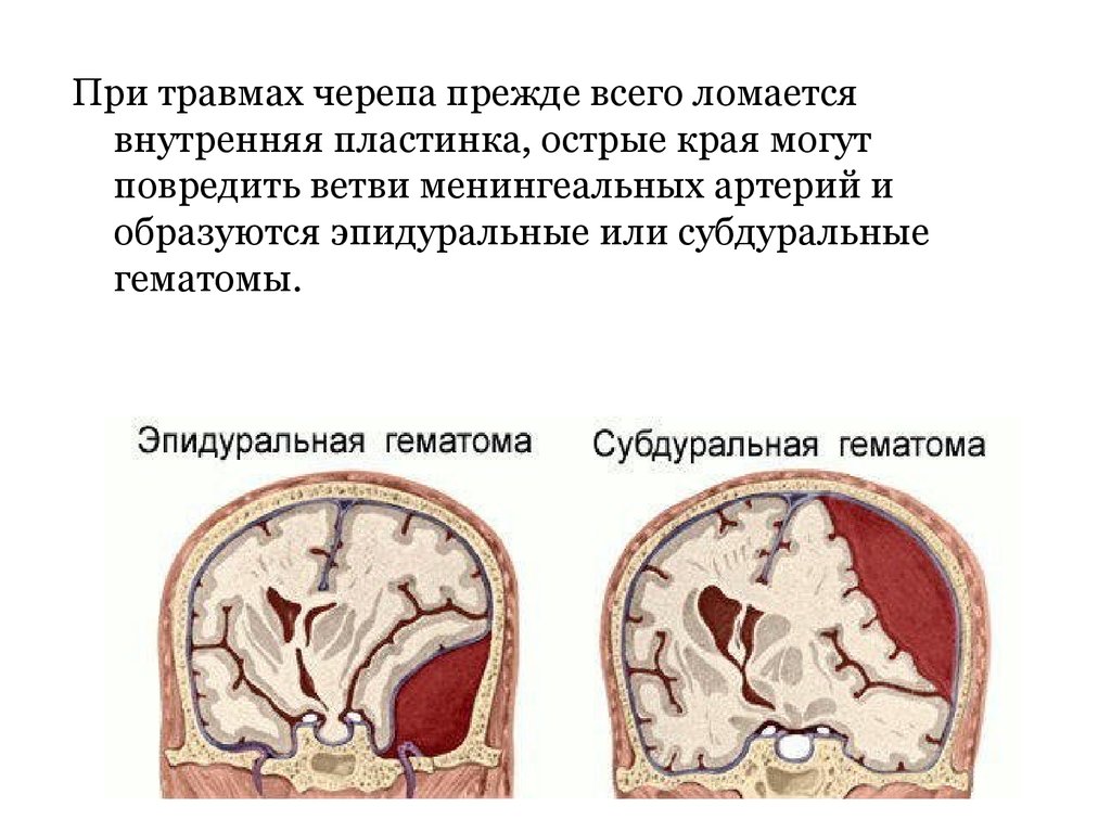 Травмы черепах. Наружная и внутренняя пластинка черепа. Наружная пластинка черепа. Внутренняя пластинка черепа. Локализация гематом при травмах черепа.