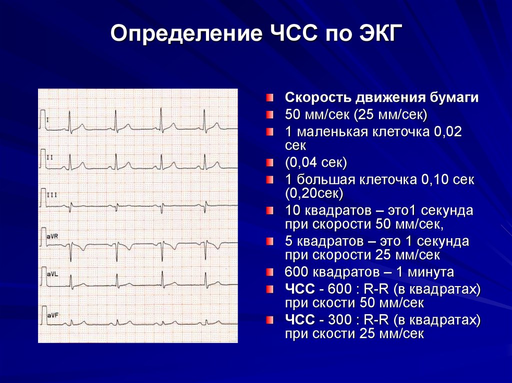 Как измерить частоту сердечных. Подсчет ЧСС на ЭКГ 25 мм/с. Как определить ЧСС по ЭКГ 25 мм. Как определить частоту сердечных сокращений по электрокардиограмме. Как считать ЧСС по ЭКГ 50 мм.