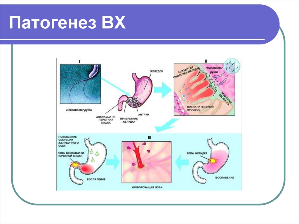 Язва желудка схема. Этиопатогенез язвенной болезни желудка. Патогенез язвы ДПК. Патогенез язвенной болезни желудка схема. Патогенез язвенной болезни 12 перстной кишки.