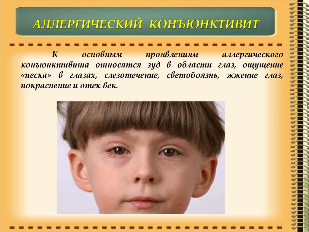 Аллергический конъюнктивит у детей фото симптомы