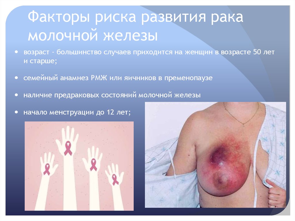 Факторы риска развития рака молочной железы