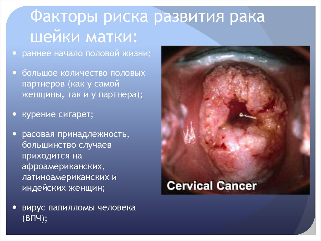 Факторы риска развития рака шейки матки: