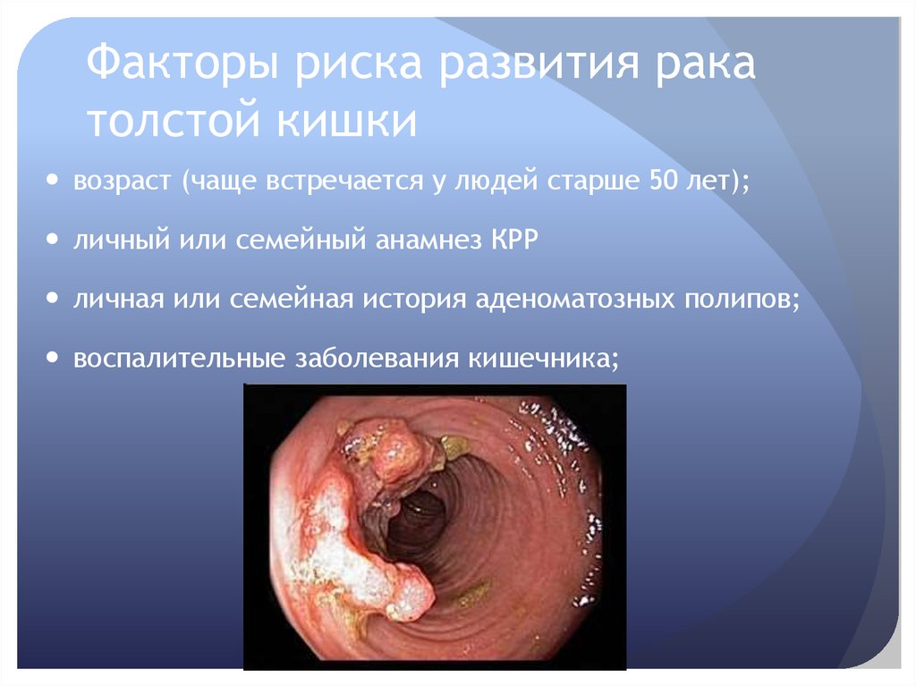 Факторы риска развития рака толстой кишки