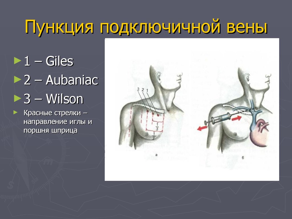 Подключичная вена. Методика пункции подключичной вены. Методика постановки подключичной вены. Скелетотопия подключичной вены. Пункция и катетеризация подключичной вены.