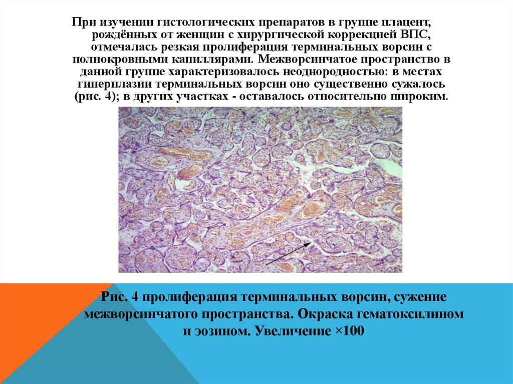 Плацента гистология. Межворсинчатое пространство плаценты гистология. Терминальные ворсины плаценты гистология. Межворсинчатый тромбоз гистология. Плацента окраска гематоксилином эозином.