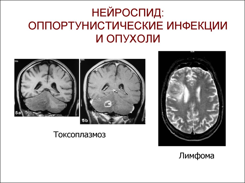 Токсоплазмоз головного мозга кт картина