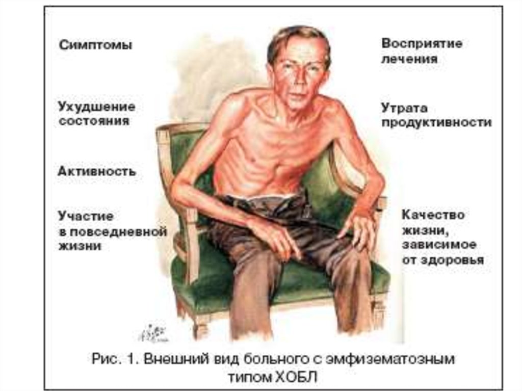 На рисунке изображен человек страдающий заболеванием. Внешний вид больного лучевой болезнью.
