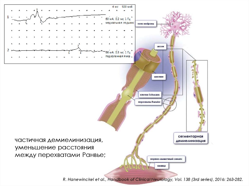 Аксонопатия. Демиелинизации нервных волокон.. Сегментарная демиелинизация. Демиелинизация нервных волокон гистология. Механизм демиелинизации периферической нервной системы.