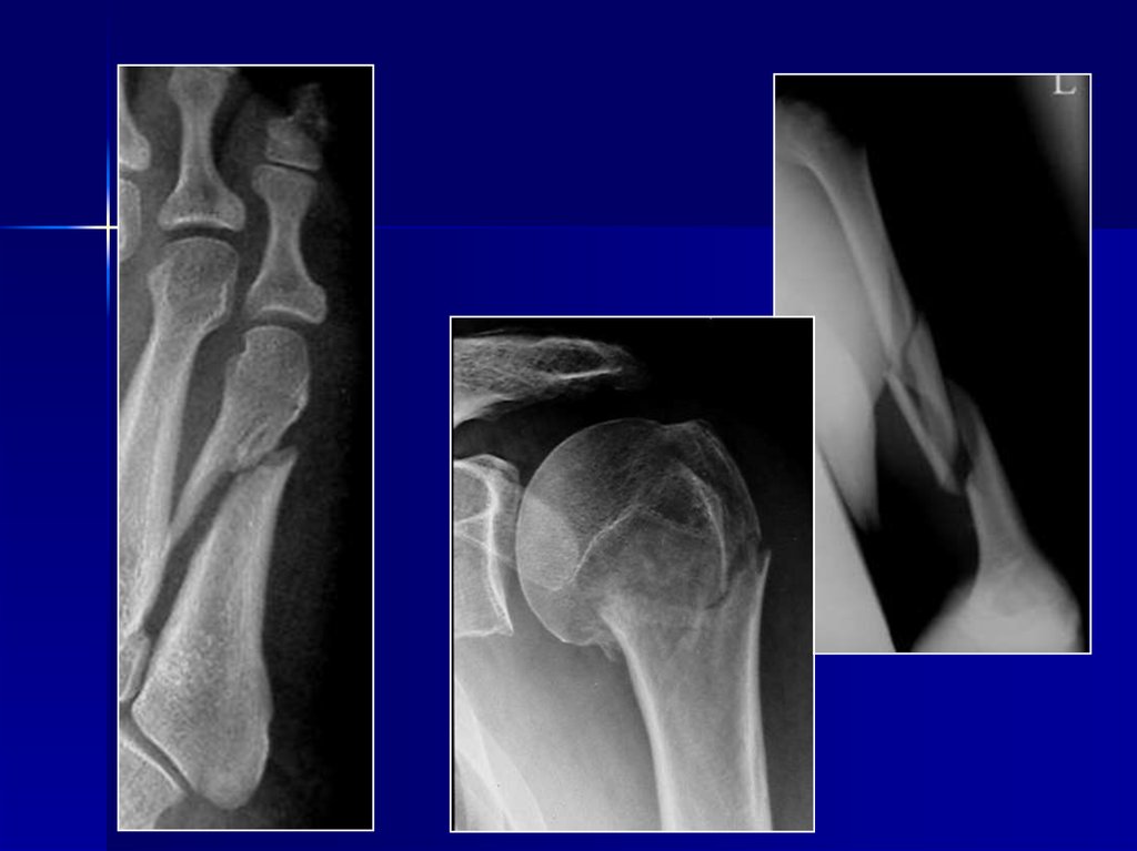 Разрыв кости. Рентгенодиагностика костей и суставов. Рентгенодиагностика травм костей. Травматические повреждения костей и суставов.