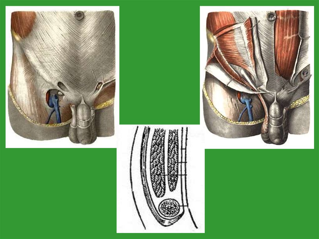 Паховые кольца у футболистов. Глубокое паховое кольцо анатомия. Поверхностное паховое кольцо анатомия. Паховый канал глубокое паховое кольцо. Паховый канал внутреннее кольцо.