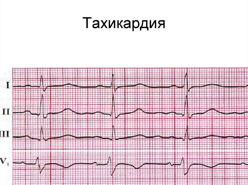 Резко сильное сердцебиение. Тахикардия. Тахикардия сердца. Учащённое сердцебиение. ЭКГ сердца.