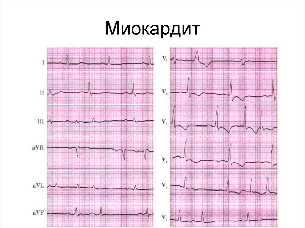 Экг диффузные. Дифтерийный миокардит ЭКГ. ЭКГ при миокардите животных. Миокардит на ЭКГ. Миокардит Абрамова-Фидлера ЭКГ.