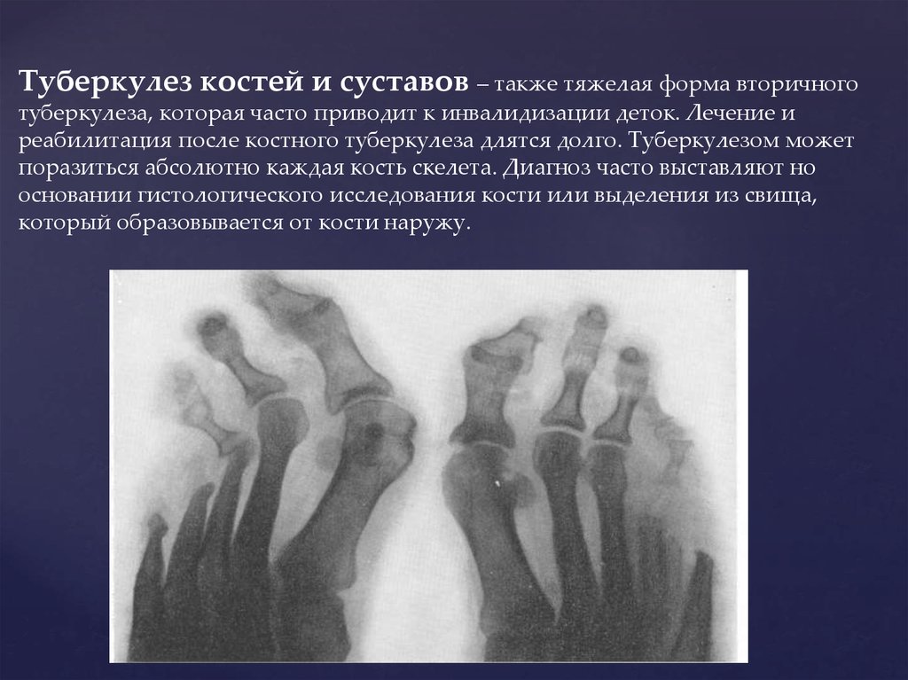 Туберкулез ноги. Костно-суставной туберкулез симптомы. Туберкулез костей и суставов.