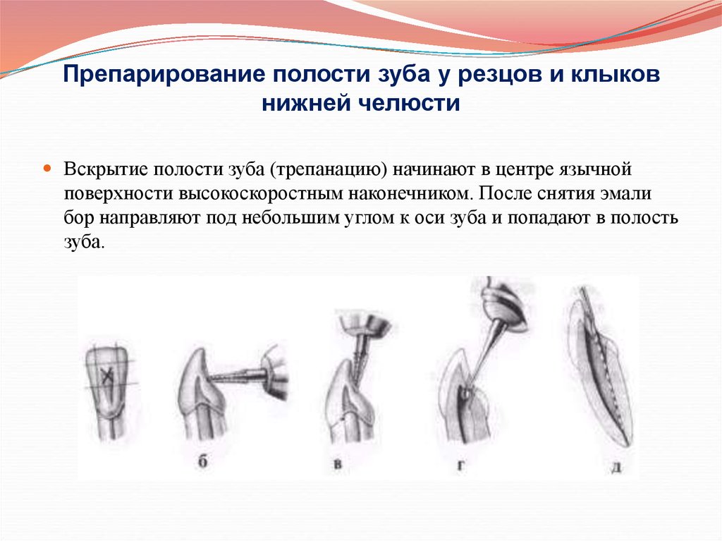 Полость зуба. Вскрытие полости зуба резец. Раскрытие полости зуба резцов и Клыков верхней челюсти. Препарирование полости зуба резцов и Клыков. Препарирование полости зуба резцов.