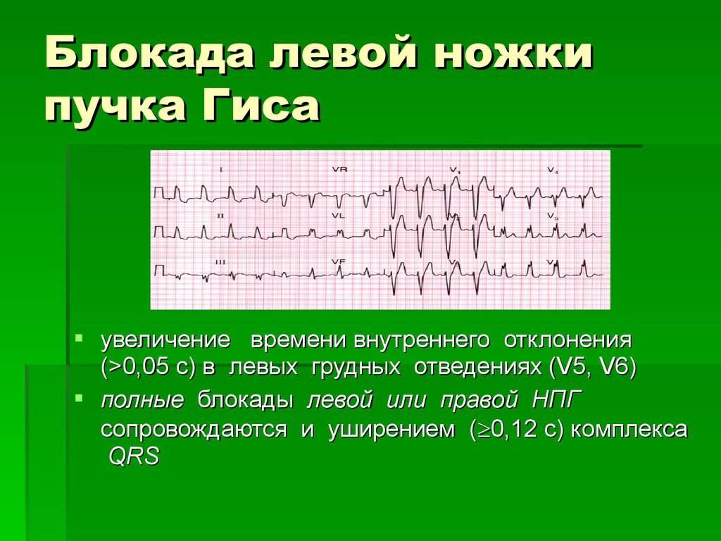 Полная блокада левой ножки гиса. Полная блокада левой ножки пучка Гиса на ЭКГ. ЭКГ при блокаде левой ножки пучка Гиса. ЭКГ критерии полной блокады левой ножки пучка Гиса. Левая блокада ножки пучка Гиса.