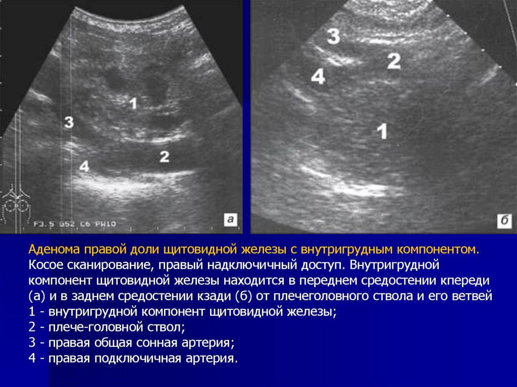 Железа аденома. Токсическая аденома щитовидной железы УЗИ. Гиперпаратиреоз аденома щитовидной железы. Аденома правой доли щитовидной железы. Аденома шишковидной железы.