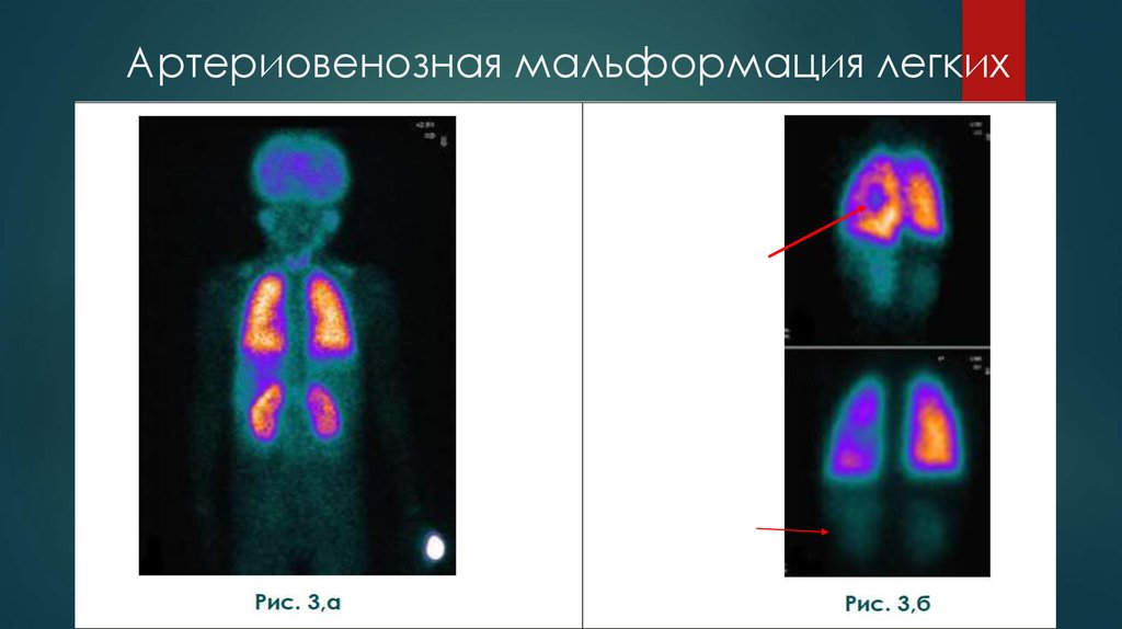 Артериовенозная мальформация легких легких