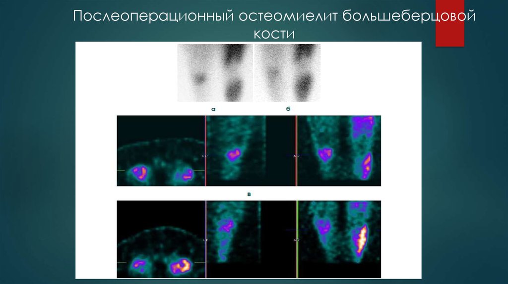 Послеоперационный остеомиелит большеберцовой кости
