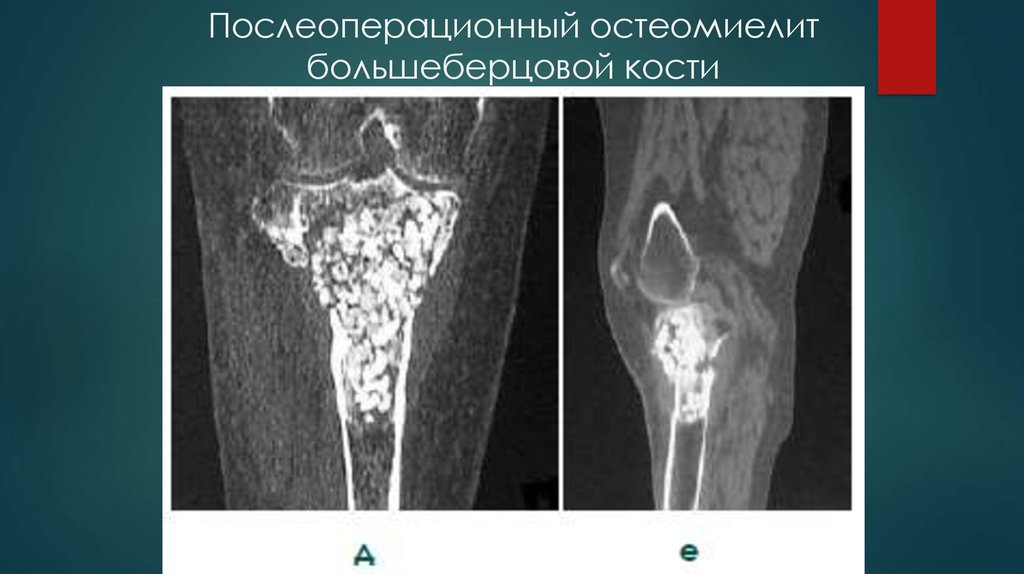 Огнестрельный остеомиелит. Хронический остеомиелит бедренной кости рентген. Гематогенный остеомиелит бедренной кости. Хронический остеомиелит большеберцовой кости кт. Хронический остеомиелит бедренной кости кт.