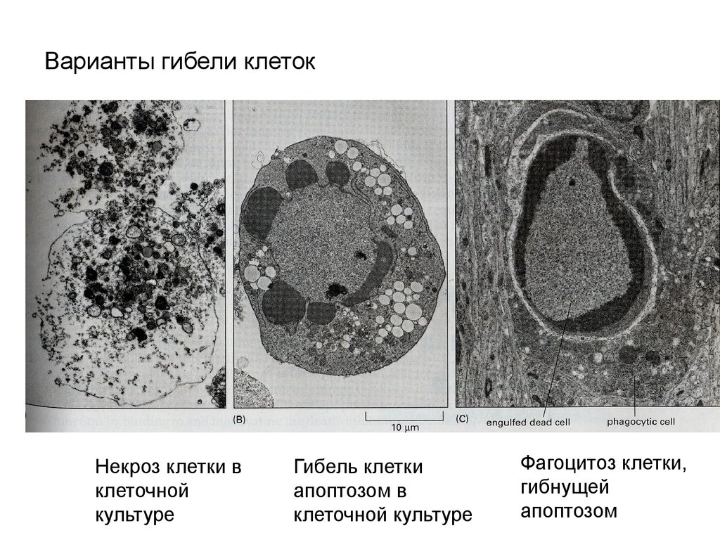 Варианты клеток. Некроз клетки микрофотографии. Гибель клетки некроз. Гибель клетки апоптоз и некроз. Стадии гибели клеток.