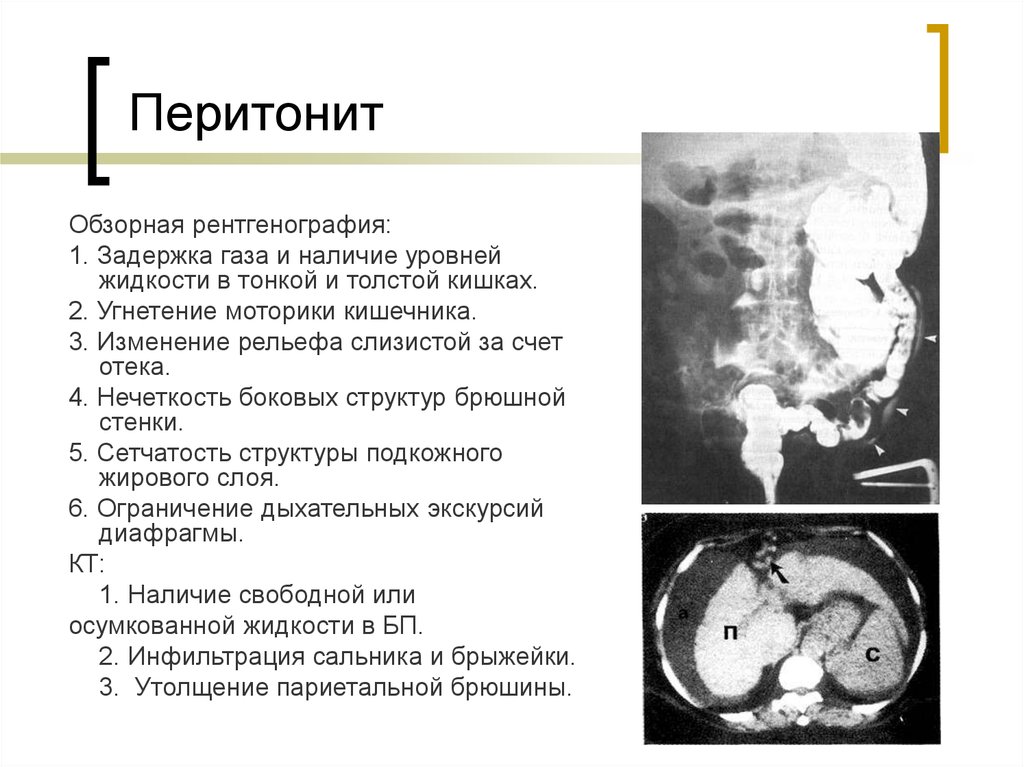 Горизонтальные уровни жидкости. Перитонит на рентгене брюшной полости. Перитонит рентген признаки.