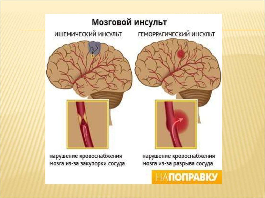 Инсульт геморрагический правая