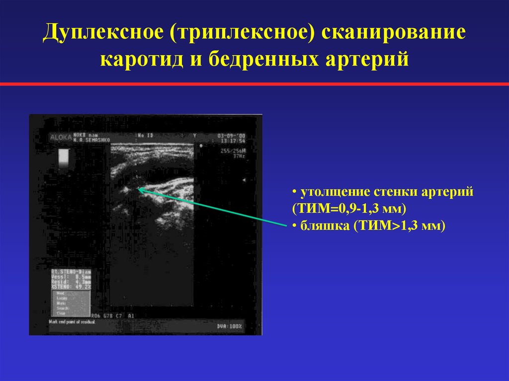 Дуплексное сканирование что это. Дуплексное и триплексное сканирование сосудов разница. Ультразвуковое дуплексное ангиосканирование. УЗИ УЗДГ брахиоцефальных сосудов. Ультразвуковая триплексное сканирование бца.