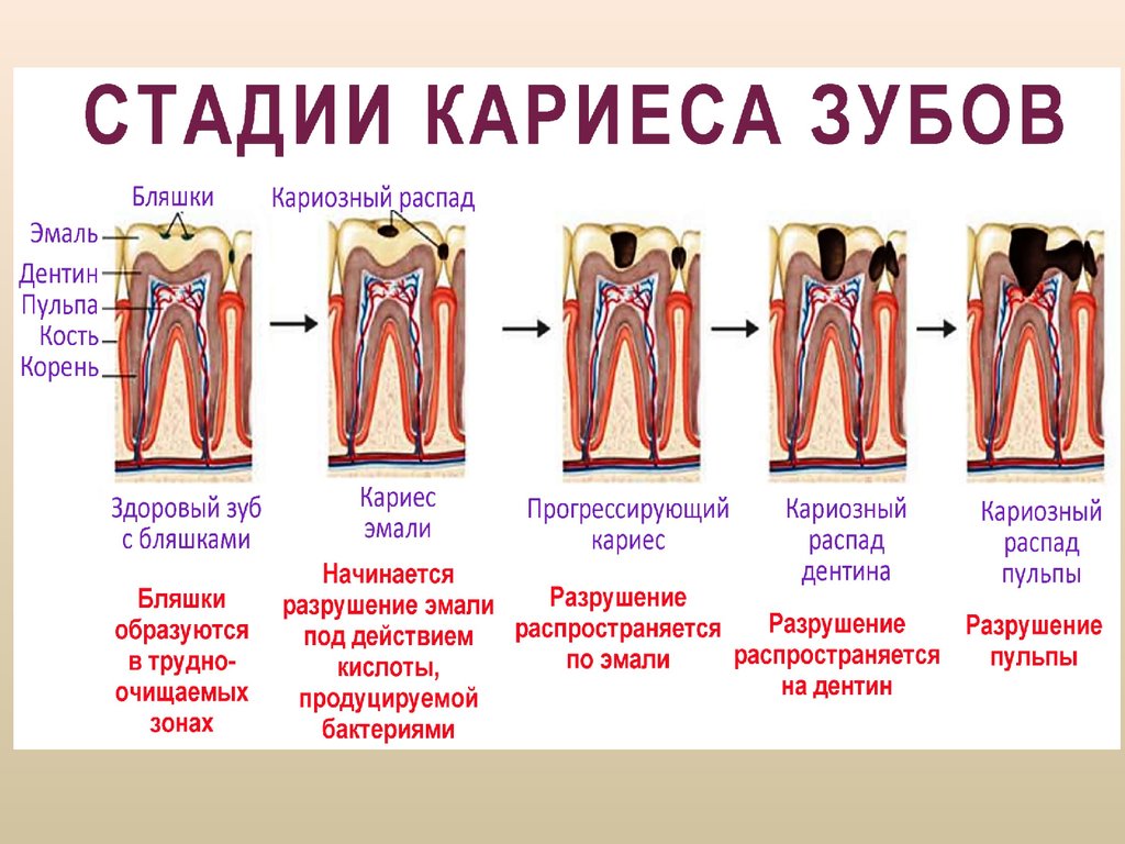 Стадии кариеса. Микробиология кариеса зубов. Иммунология полости рта презентация.