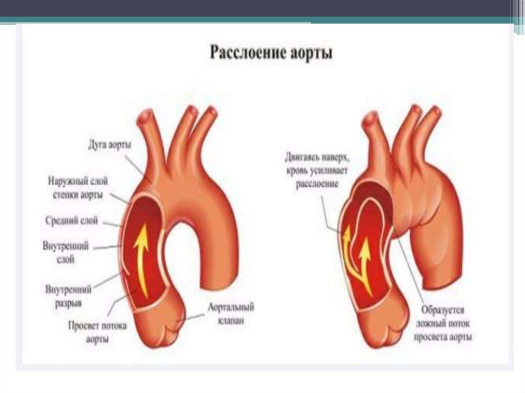 Расширение аорты сердца