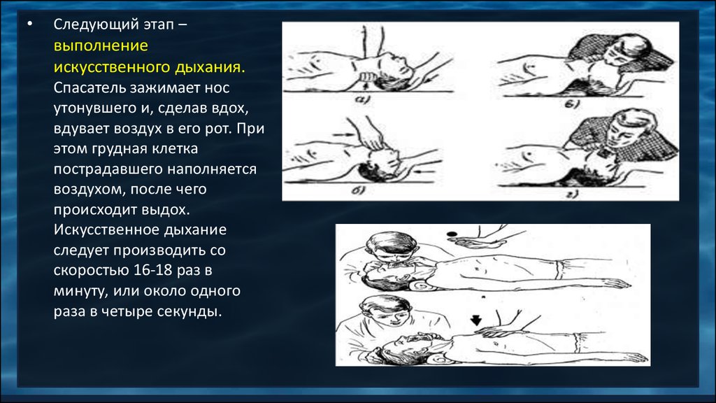 Удаление воздуха из желудка при искусственном дыхании