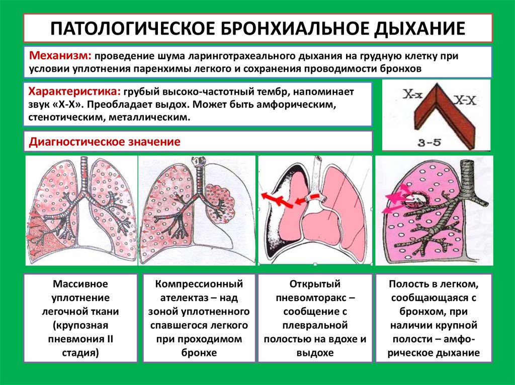 Бронхолегочные заболевания реабилитация. Инфильтрационное бронхиальное дыхание. Тип дыхания при бронхите. Разновидности патологического бронхиального дыхания. Механизм дыхательной недостаточности при пневмонии:.
