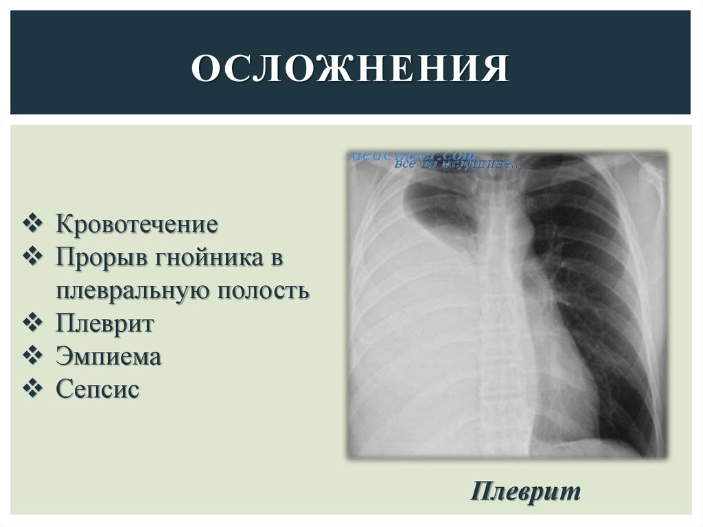 Абсцесс лёгкого - презентация онлайн