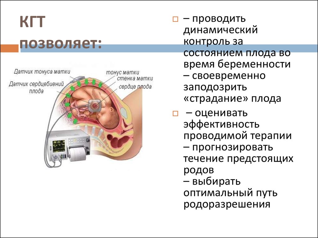 Тонус матки. КГТ плода при беременности что это такое. Внутренняя КТГ.