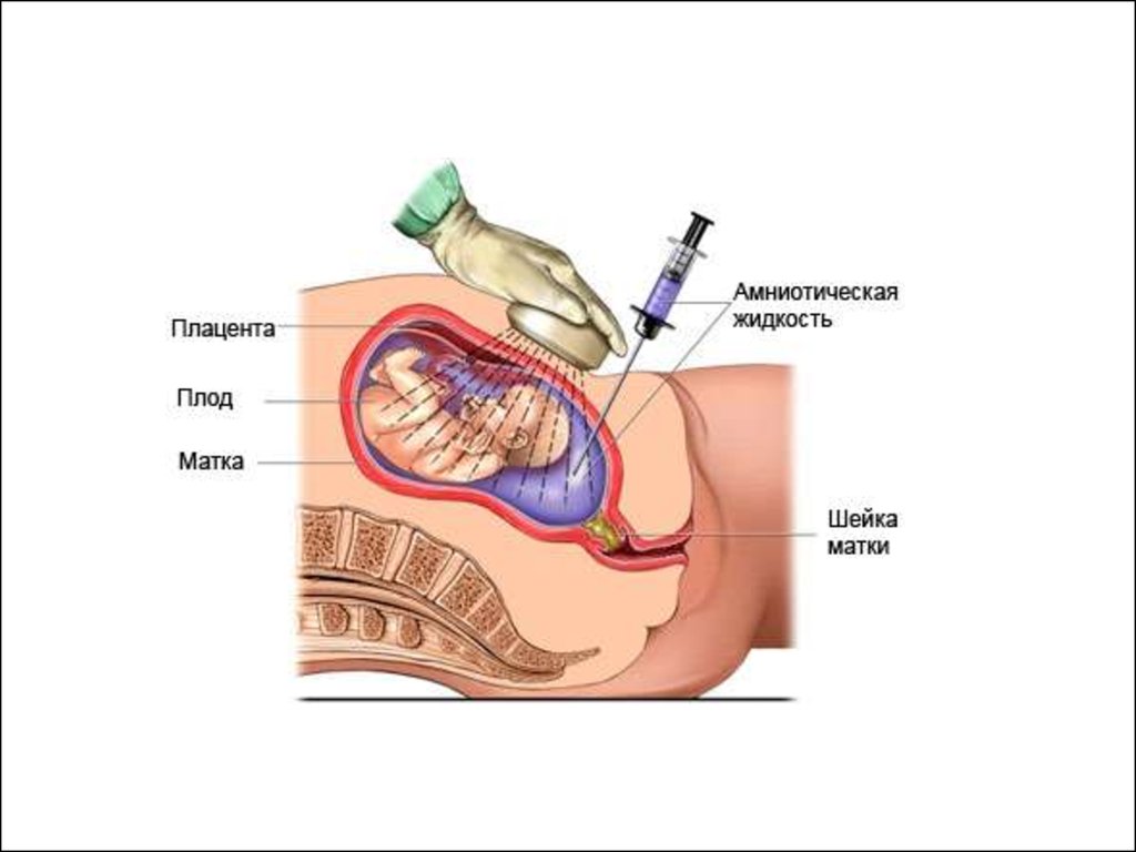 Амниотический тяж. Исследование околоплодных вод амниоцентез. Амниоцентез абдоминальная. Пункция амниотической жидкости. Амниоцентез это в акушерстве.