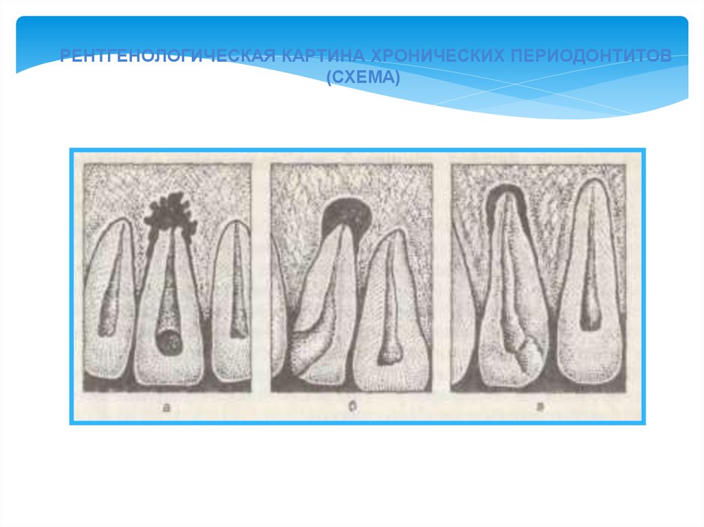 Хронический периодонтит этиология. Рисунок рентгена острого и хронического периодонтитов. Формы периодонтита и рентгенологической картины в области апекса. Рентгенологическая картина острого периодонтп. Картина хронического одонтогенного синусита на фоне периодонтита..