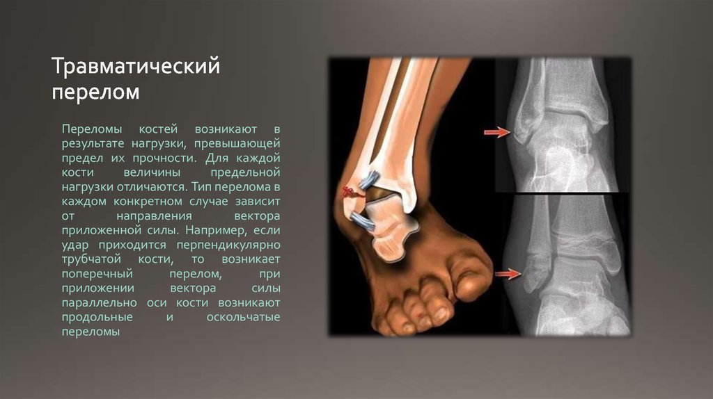 Переломы травматология презентация