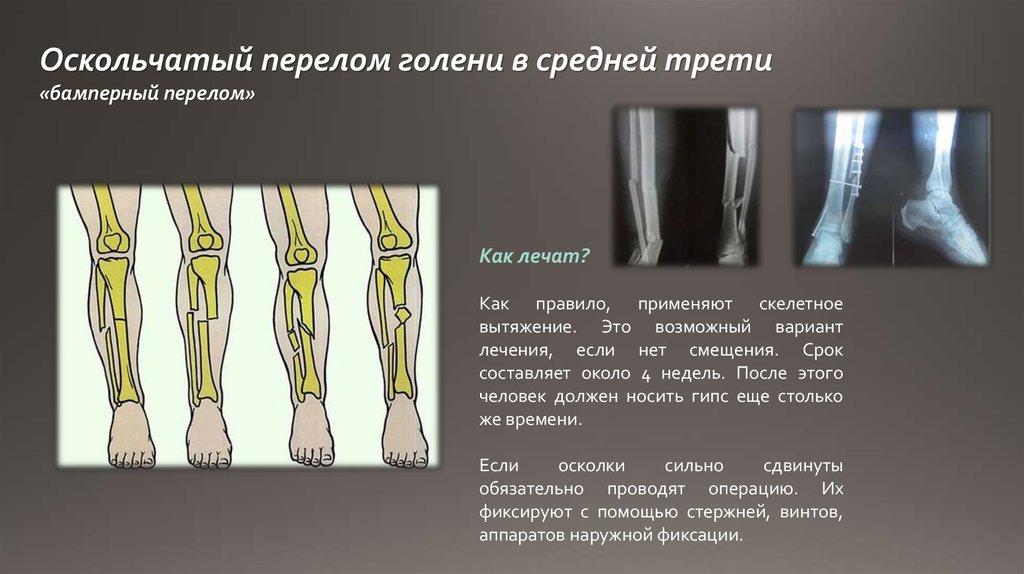 Нижней трети правой голени. Многооскольчатый перелом голени рентген. Диафизарные переломы костей голени. Перелом 2 берцовых костей. Перелом средней трети голени.