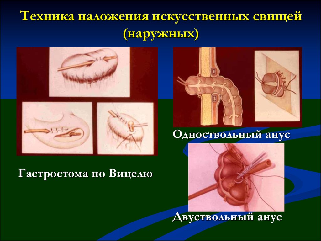 Свищ на послеоперационном шве фото