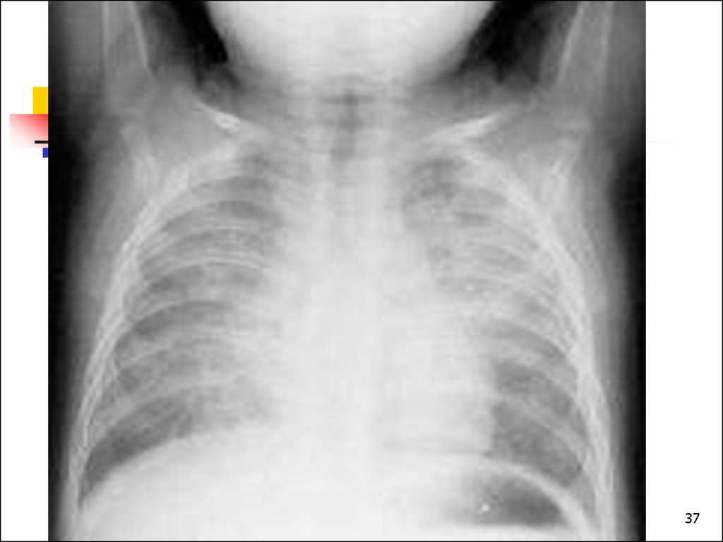 Pneumonia In Children. Diagnostics And Treatment - презентация онлайн