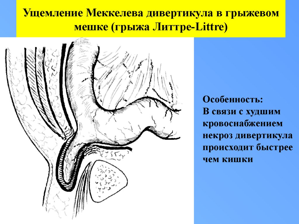 Грыжа казакша презентация