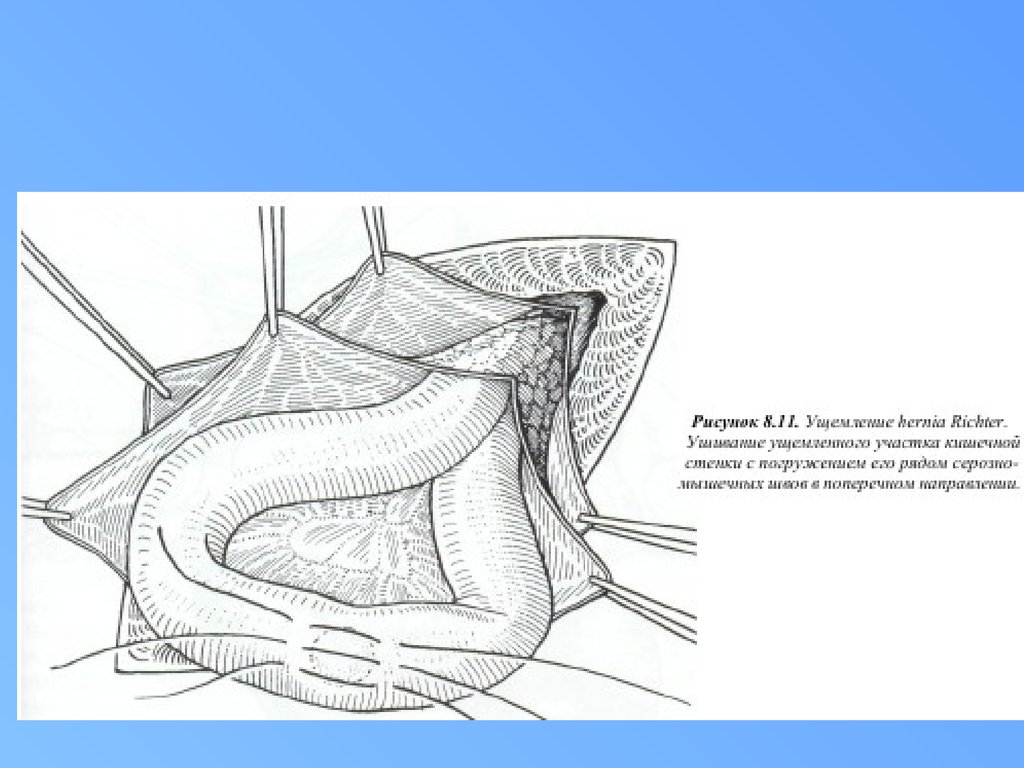 Грыжевой мешок. Грыжа сальниковой сумки грыжевые ворота. Диаметр грыжевых ворот это. Пластическое закрытие грыжевых ворот.