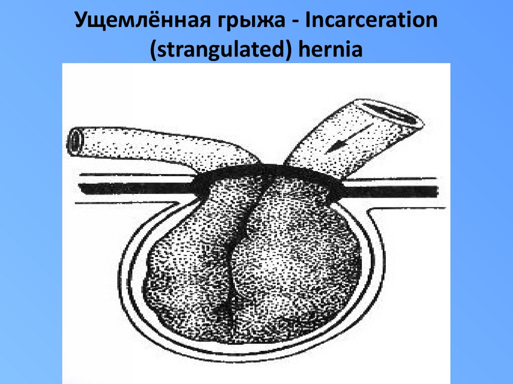 Паховая грыжа рисунок