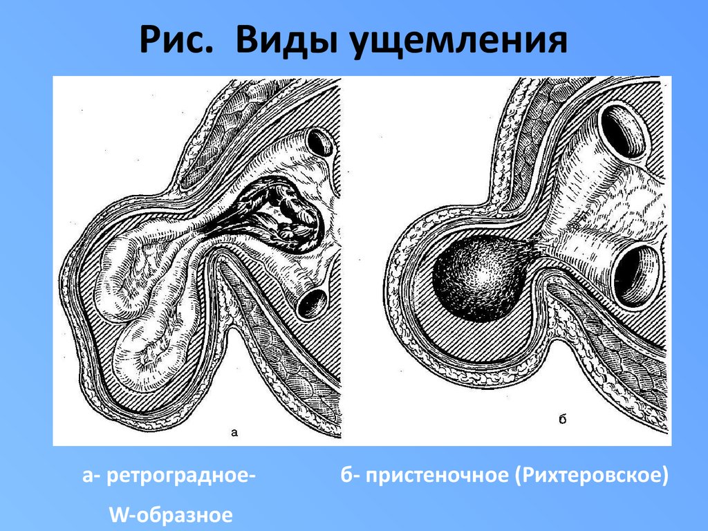 Какова клиническая картина при рихтеровском ущемлении