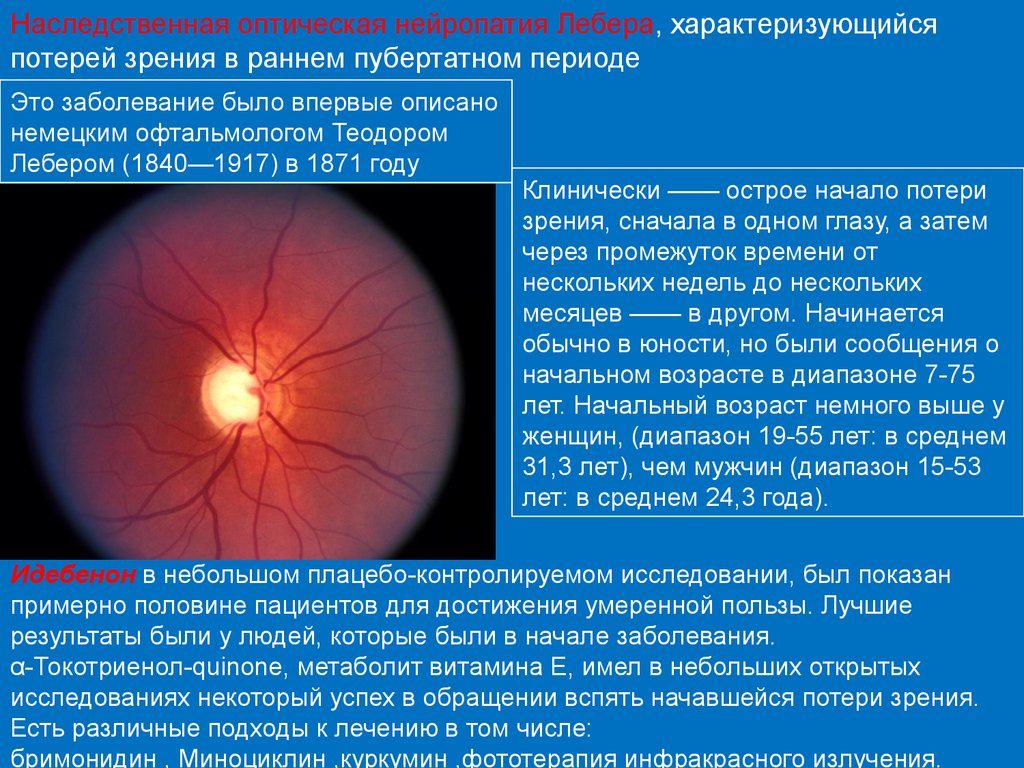 Нейропатия глаза. Атрофия зрительного нерва Лебера. Задняя ишемическая нейропатия зрительного нерва. Наследственная атрофия зрительных нервов Лебера.