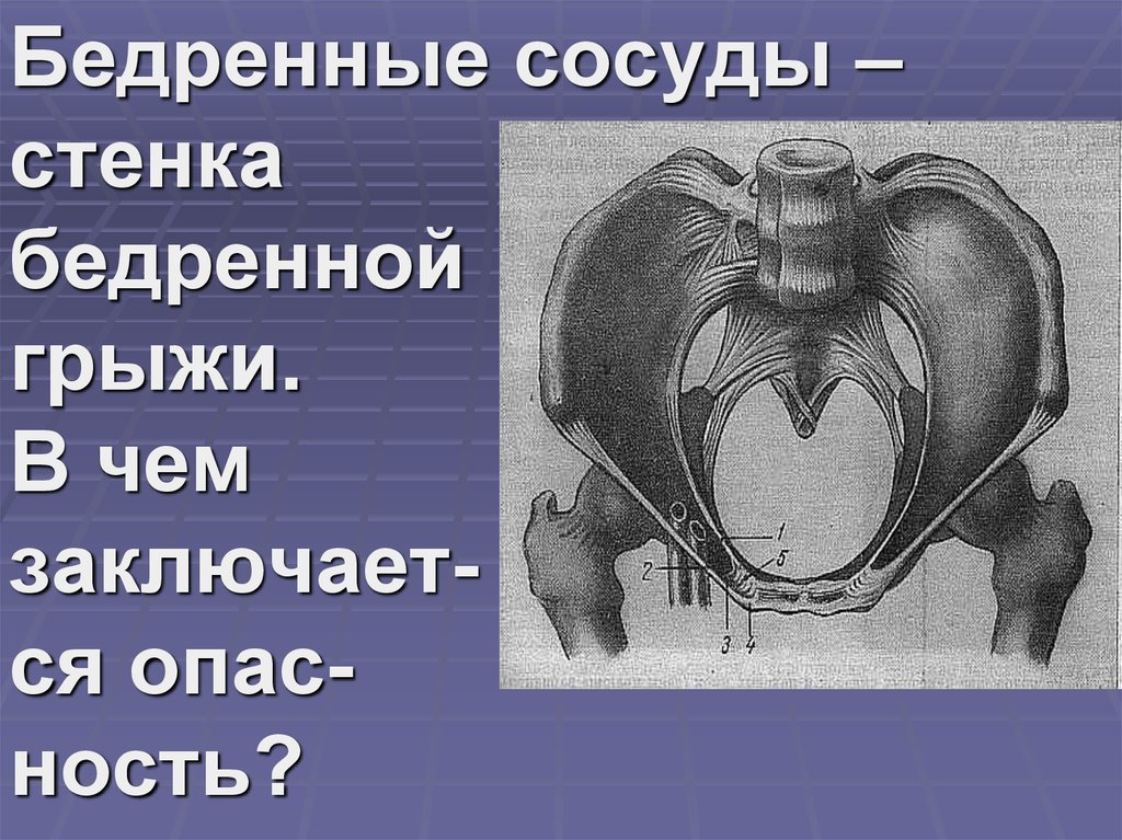 Бедренная грыжа стенки